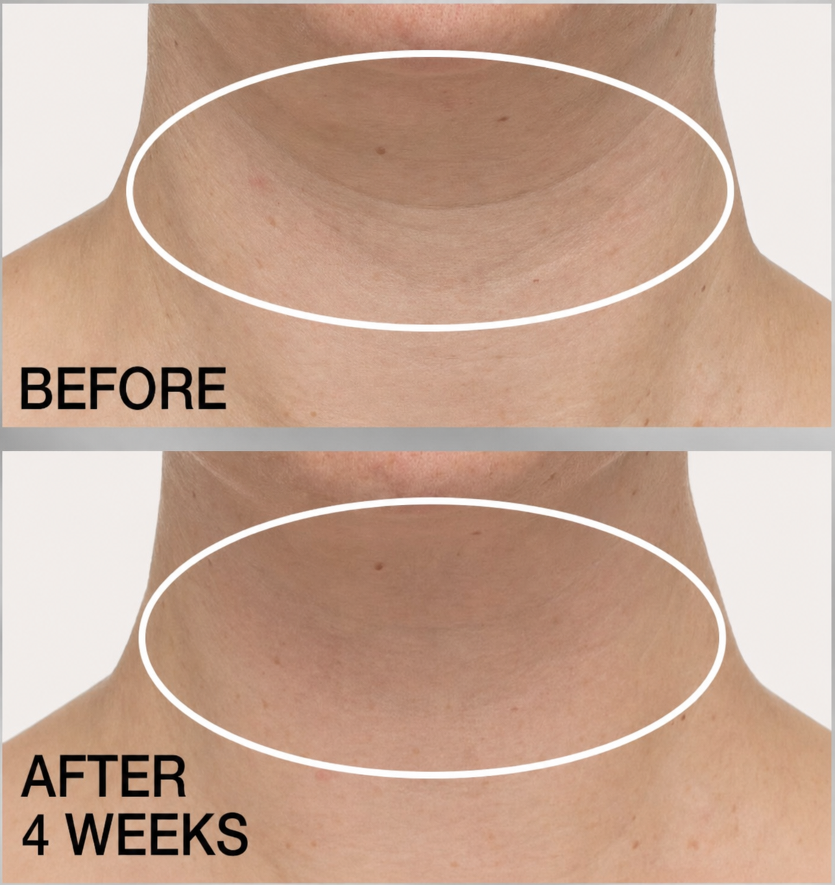 Before and after neck appearance